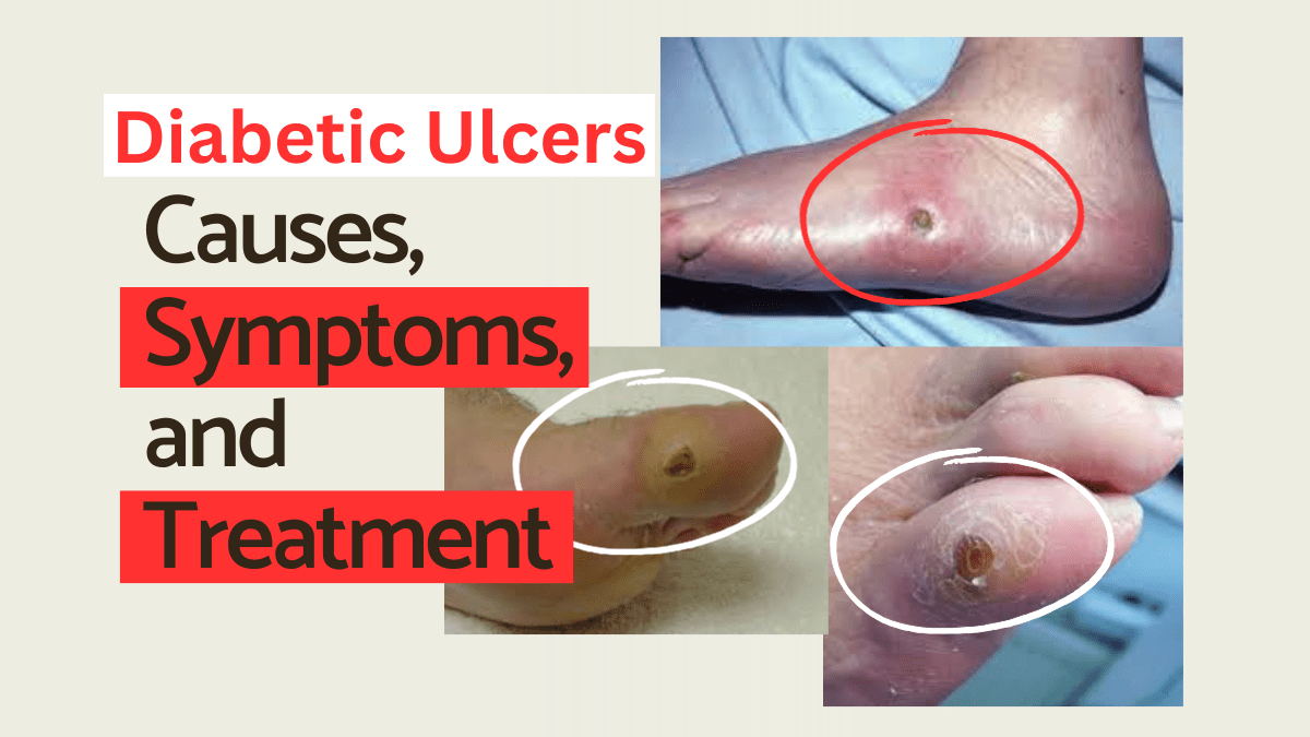 Diabetic Ulcers: Causes, Symptoms, And Treatment